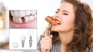 benefits of dental implants