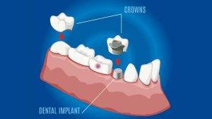 Dental Implants in Browns Plains