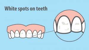 White Spots on Teeth