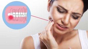 Wisdom Tooth Removal: What You Should Expect