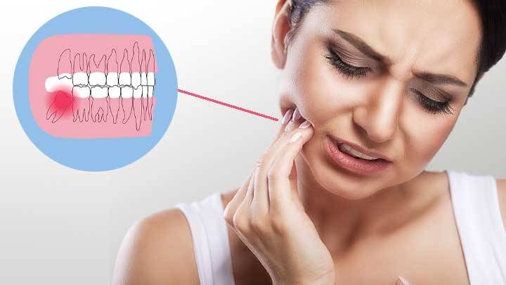 Wisdom Tooth Removal: What You Should Expect