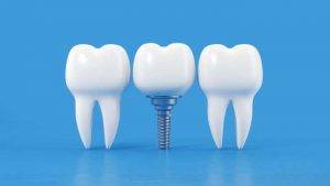 Dental Implants Faqs