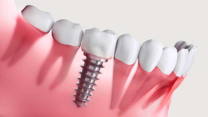 an-overview-of-dental-implants