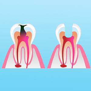 Root Canal Treatment in Browns Plains