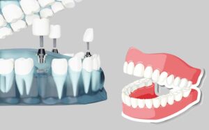Dentures and Dental Implants