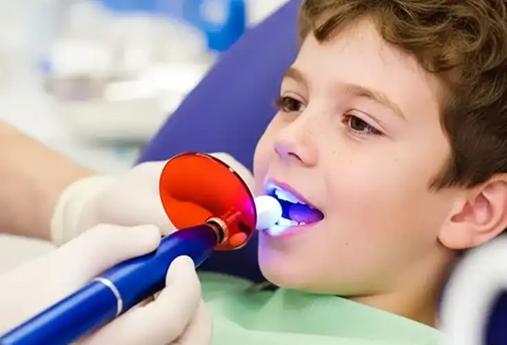 Fissure Sealants – Keep food and bacteria at bay